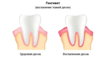 Причини підвищеного слиновиділення у дорослих - як позбутися від гіперсалівації - (причини) Причини підвищеного слиновиділення у дорослих - як позбутися від гіперсалівації -