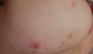 Прищі на колінах 1