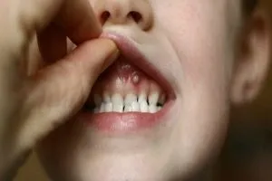 Прищ на яснах причини появи і способи лікування (лікування) Прищ на яснах причини появи і способи лікування