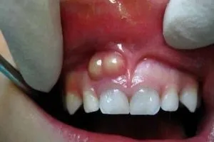 Прищ на яснах причини появи і способи лікування (лікування) Прищ на яснах причини появи і способи лікування