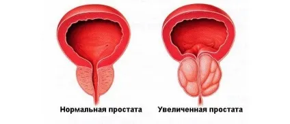 Застосування гомеопатії при простатиті у чоловіків (застосування) Застосування гомеопатії при простатиті у чоловіків