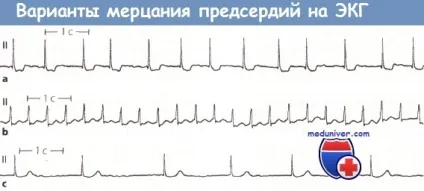 Ознаки мерехтіння передсердь на ЕКГ (шлуночків дорівнює приблизно) Ознаки мерехтіння передсердь на ЕКГ