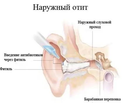 Застосування камфорного масла для лікування отиту вуха - будьте здорові (лікування) Застосування камфорного масла для лікування отиту вуха - будьте здорові