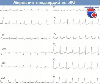 Ознаки мерехтіння передсердь на ЕКГ (хворих мерехтінням передсердь) Ознаки мерехтіння передсердь на ЕКГ