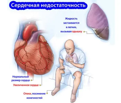 Проблеми з серцем симптоми, які ознаки хворого серця (хворого) Проблеми з серцем симптоми, які ознаки хворого серця