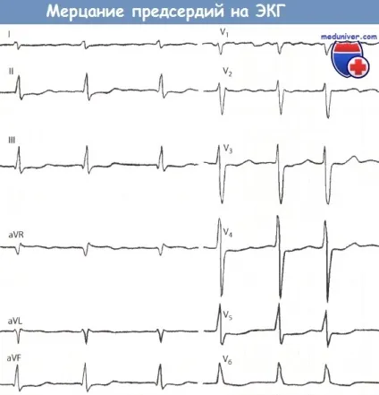 Ознаки мерехтіння передсердь на ЕКГ (мерехтіння) Ознаки мерехтіння передсердь на ЕКГ