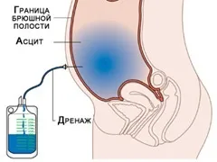 пункція абдомінальна