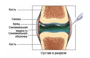 Протези синовіальної рідини - препарати на основі гіалуронової кислоти (синовіальної) Протези синовіальної рідини - препарати на основі гіалуронової кислоти