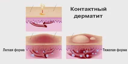 Простий контактний дерматит ознаки, причини, лікування (ознаки) Простий контактний дерматит ознаки, причини, лікування