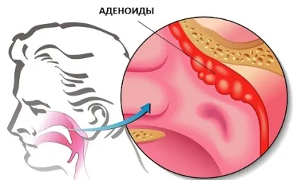 Промивання носа і носоглотки методом зозулі що таке, апарати, як роблять в домашніх умовах (промивання) Промивання носа і носоглотки методом зозулі що таке, апарати, як роблять в домашніх умовах