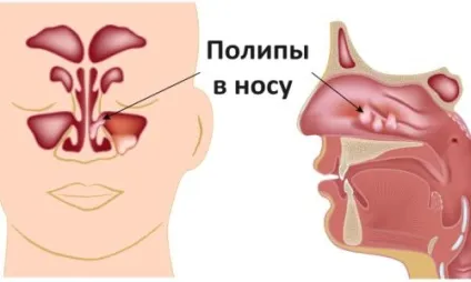 Промивання носа і носоглотки методом зозулі що таке, апарати, як роблять в домашніх умовах (промивання) Промивання носа і носоглотки методом зозулі що таке, апарати, як роблять в домашніх умовах