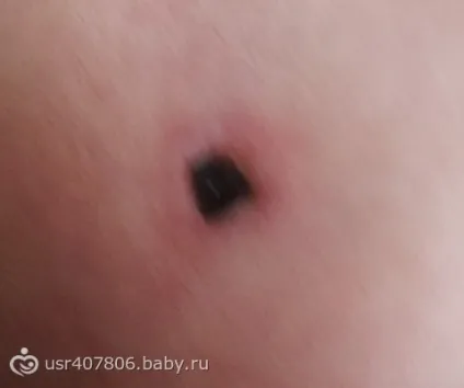 Розповідь про нашому випадку припікання гемангіоми на спині (гемангіоми) Розповідь про нашому випадку припікання гемангіоми на спині