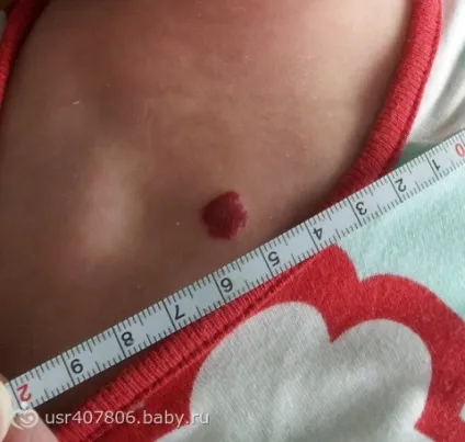 Розповідь про нашому випадку припікання гемангіоми на спині (о) Розповідь про нашому випадку припікання гемангіоми на спині