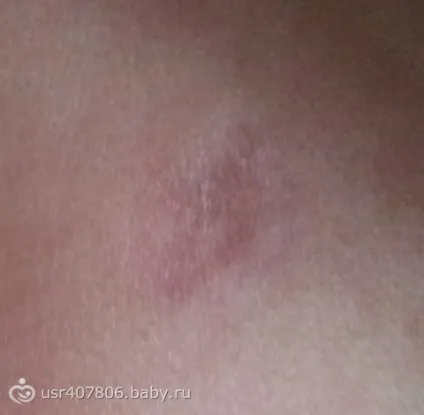Розповідь про нашому випадку припікання гемангіоми на спині (нашому) Розповідь про нашому випадку припікання гемангіоми на спині