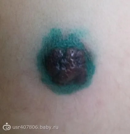 Розповідь про нашому випадку припікання гемангіоми на спині (припікання) Розповідь про нашому випадку припікання гемангіоми на спині