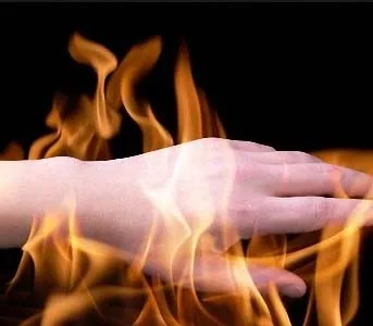Як швидко прибрати опік, як прибрати сліди від опіку (опік) Як швидко прибрати опік, як прибрати сліди від опіку
