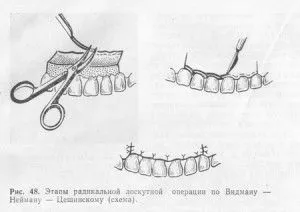 Ретракція ясен і ретракционная нитку в стоматлогіі (нитка) Ретракція ясен і ретракционная нитку в стоматлогіі