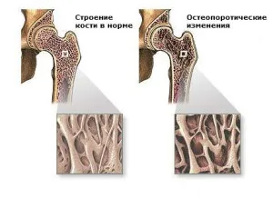 Саркома кістки - причини, симптоми, наслідки, діагностика і лікування (саркома) Саркома кістки - причини, симптоми, наслідки, діагностика і лікування