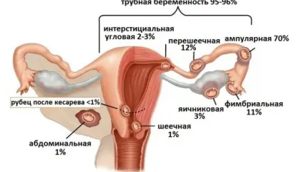Шеечная вагітність симптоми і лікування (вагітність) Шеечная вагітність симптоми і лікування