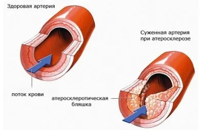 Шийна мігрень причини, симптоми і лікування (мігрень) Шийна мігрень причини, симптоми і лікування
