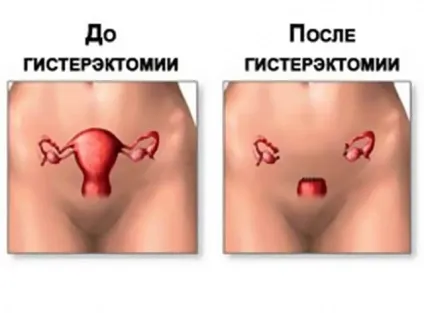 Скільки триває операція з видалення матки