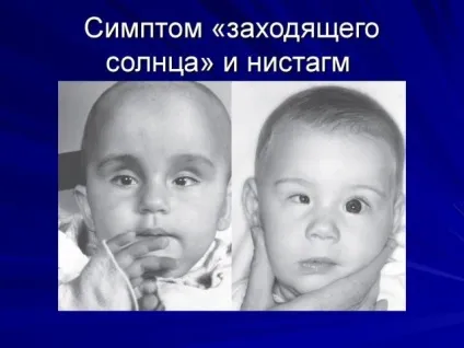 Симптом сонця у новонароджених причини і виявлення синдрому
