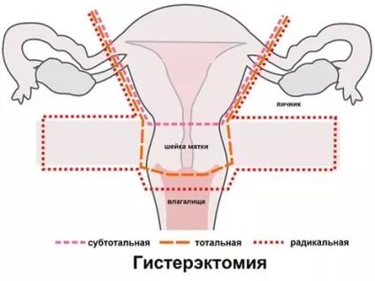 Скільки триває операція з видалення матки