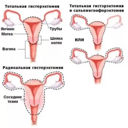 Скільки триває операція з видалення матки