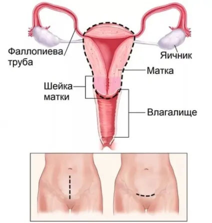 Скільки триває операція з видалення матки