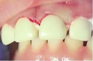 Сучасні методи відновлення зруйнованих молочних передніх зубів у дітей (молочних) Сучасні методи відновлення зруйнованих молочних передніх зубів у дітей