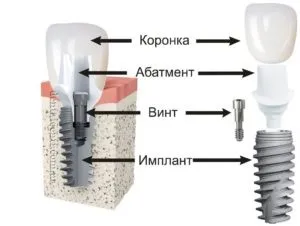 Термін служби зубних імплантів і що на нього впливає, ціни, фото (зубних) Термін служби зубних імплантів і що на нього впливає, ціни, фото