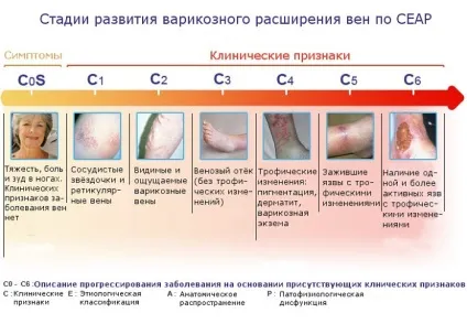 Стадії варикозної хвороби, початкова стадія варикозу на ногах лікування (стадія) Стадії варикозної хвороби, початкова стадія варикозу на ногах лікування