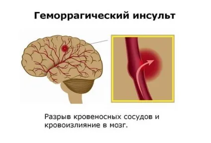 Субарахноїдальний крововилив види, причини виникнення, симптоми, діагностика, лікування,