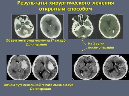 Субарахноїдальний крововилив види, причини виникнення, симптоми, діагностика, лікування,