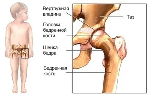 Які ортопедичні проблеми часто зустрічаються у немовлят