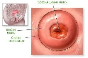 Світло-коричневі виділення перед місячними - це небезпечно (місячними) Світло-коричневі виділення перед місячними - це небезпечно