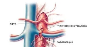 Тромбоз мезентеріальних судин - причини, діагностика, клініка та лікування (причини) Тромбоз мезентеріальних судин - причини, діагностика, клініка та лікування