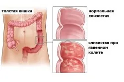 Бурчання в животі після їжі причини і лікування (причини) Бурчання в животі після їжі причини і лікування