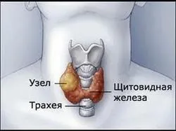Зменшена щитовидна залоза наслідки патології (наслідки) Зменшена щитовидна залоза наслідки патології