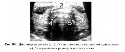 Ультразвукове дослідження паращитовидних залоз (дослідження) Ультразвукове дослідження паращитовидних залоз