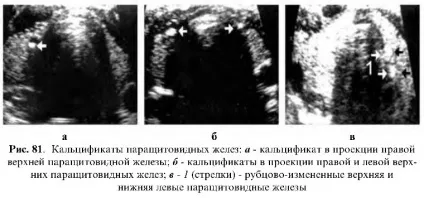 Ультразвукове дослідження паращитовидних залоз (паращитовидних) Ультразвукове дослідження паращитовидних залоз