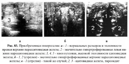 Ультразвукове дослідження паращитовидних залоз (дослідження) Ультразвукове дослідження паращитовидних залоз
