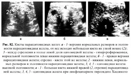 Ультразвукове дослідження паращитовидних залоз (ультразвукове дослідження паращитовидних) Ультразвукове дослідження паращитовидних залоз