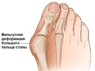 Вальгусна деформація великого пальця стопи причини, симптоми, діагностика та лікування (деформація) Вальгусна деформація великого пальця стопи причини, симптоми, діагностика та лікування