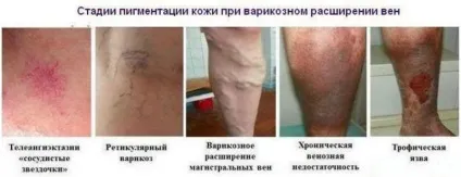 Варикозний дерматит нижніх кінцівок - симптоми і лікування (симптоми) Варикозний дерматит нижніх кінцівок - симптоми і лікування