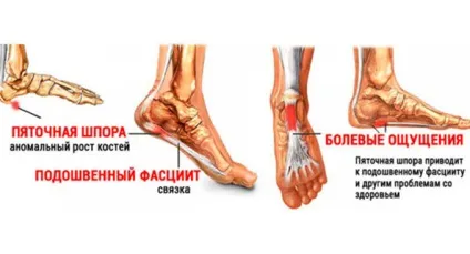 Дізнайтеся як вилікувати п'яткову шпору (п'яткову) Дізнайтеся як вилікувати п'яткову шпору