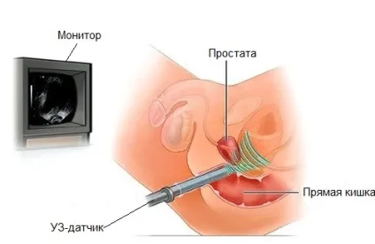 Узі передміхурової залози трансабдоминально показання і техніка (залози сечового міхура) Узі передміхурової залози трансабдоминально показання і техніка
