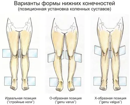 Варусна деформація гомілки і її виправлення