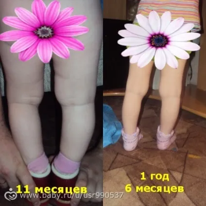 Варусна деформація гомілки (історія з фото) (історія) Варусна деформація гомілки (історія з фото)
