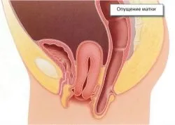 Випадання шийки матки